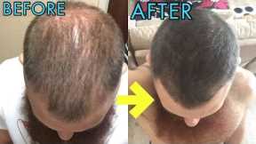 CRAZY MICRO-NEEDLING BEFORE/AFTER RESULTS FOR HAIR REGROWTH!