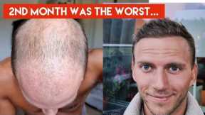 My Hair Transplant Journey - The AWFUL first 4 months (in-depth walkthrough week by week)