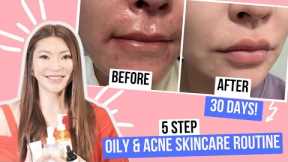 Skin Care Routine Acne Oily Skin | How I Got Clear Skin in 30 Days