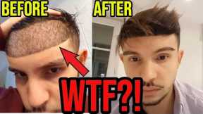 The LOWEST Hairline I’ve EVER Seen From A Hair Transplant!! **UNBELIEVABLE**