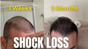 When Do Hair Transplants Start To Grow? Prepare Yourself Mentally For Surgery