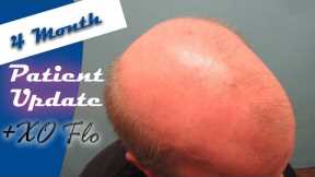 Norwood 7 Hair Loss Treatment - Patient Update with Adam
