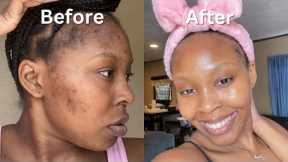 How I Cleared My Acne + Dark Spots + Hyperpigmentation for good in 1 month (NO ACCUTANE) VIDEO PROOF