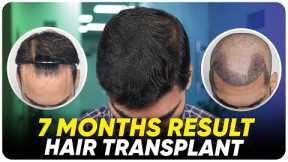 Hair Transplant Time Lapse | Step by Step Hair Transplant Surgery Time Lapse