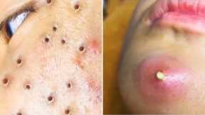 Popping Giant Pimple & Popping Huge Blackheads   Best Pimple Popping Video #21