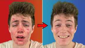 Best Remedies to Cure Acne! // Eradicate Blemishes & Prevent Breakouts!
