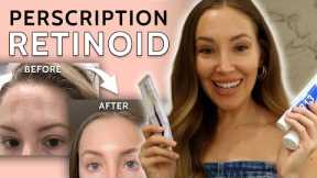 How my Skin Has Changed From Prescription Retinoid