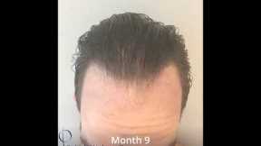 TimeLapse of Hair Transplant Growth