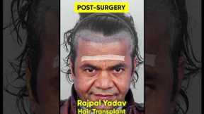 Bollywood Actor Rajpal Yadav Hair Transplant | Matchless Hair Transplant Results of Comedy King