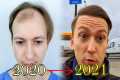 FUE Hair Transplant Growth Timeline | 