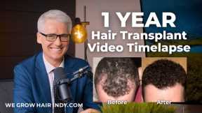 Hair Transplant - 1 Year Video Timelapse - We Grow Hair Indy