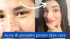 All about Acne|Pimples prone skincare,products & treatment ✨