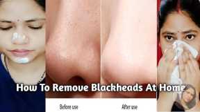 How To Remove Blackheads &Whiteheads ||5 Hacks to get Rid of Blackheads in 1day!  #homeremedies