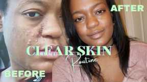 How I Cleared My Acne | Glass Skin Skincare Routine