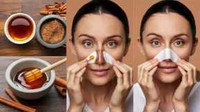 Easy Home Remedies to Get Rid of Blackheads/homemade skin care