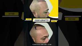 Hair Transplant in our patient. 2500 grafts | Care4Hair