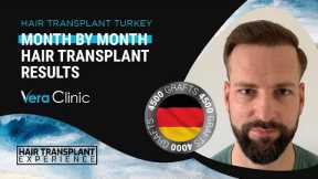 Month by Month #hairtransplant Time Lapse Before After Results #hairtransplantturkey #4500grafts