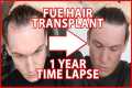 FUE Hair Transplant Timeline 1 YEAR | 