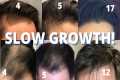 Hair Transplant Slow Growers Watch
