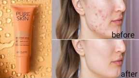 Summer acne problems/Solution in this video|Full details| Must watch this video