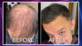 I had PRP (platelet rich plasma) therapy for hair loss instead of a hair transplant. (Part 1)