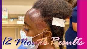 Ashley's Amazing 1 Year Hair Transplant Results for Black Women