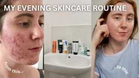 An Evening Skincare Routine For Acne-Prone Skin THAT REALLY WORKS!