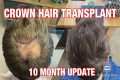 SUCCESSFUL CROWN HAIR TRANSPLANT -