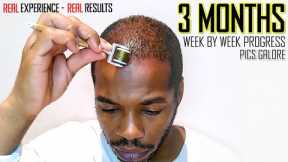 Derma roller Hair Regrowth Results 3 Months | Month by Month Progress