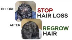 How To Stop Hair Loss & Regrow Hair I Hindi I Complete Guide Of Hair Care