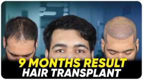 Hair Transplant in Istanbul | Best Results & Cost of Hair Transplant in Istanbul