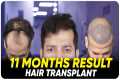 Hair Transplant in Salem | Best