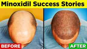 MINOXIDIL - A Step-by-Step Guide to Regain Your Hair