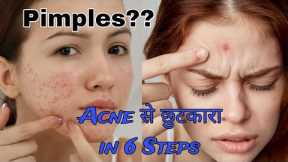 How To Remove Pimples | How To Get Rid Of Pimples | Acne #video #viralvideo #youtubevideo #acne #diy