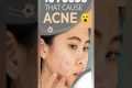 Oily acne prone skin care | oily skin 