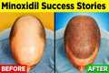 MINOXIDIL - A Step-by-Step Guide to