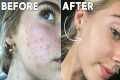 How I Cleared My Skin In 8 Weeks