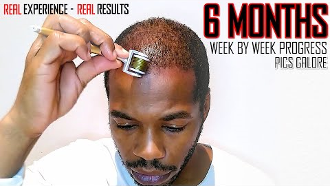 Derma roller Hair Regrowth Results 6 Months | Month by Month Progress | Coffee as a DHT Blocker