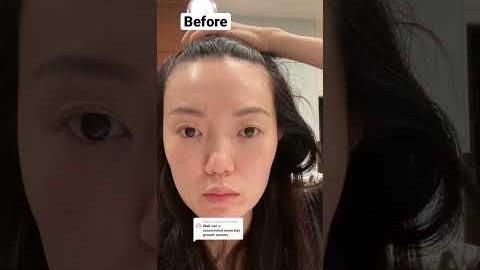 These were my results after 1 month of using my Maya Chia hair growth serum + Nutrafol supplements