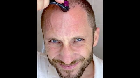 How I Use DermaRoller for Hair Growth and To Solve my Baldness and Hair Loss Tutorial 4k