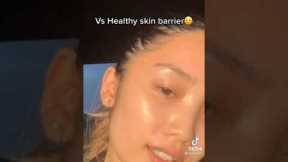 FROM ACNE TO CLEAR SKIN JOURNEY |SKINCARE TIKTOK #SHORTS