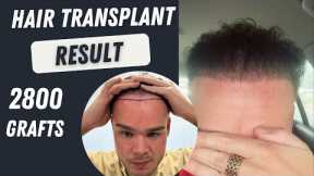 Hair Transplant Before and After 3000 Grafts Result 10 months | Hair Transplant Timelapse