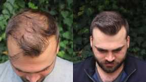 Hair Transplant Result with 3040 Grafts | EXTREME TRANSFORMATION from 0 days to 10 Months