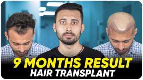 Hair Transplant in Spain | Best Results & Cost of Hair Transplant in Spain