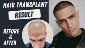 Hair Transplant Before and After |  Hair Transplant Result | Hair Transplant Timelapse