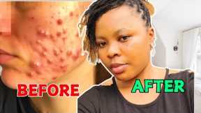 How to Clear Acne and Pimples Fast on face/ Clear acne Scars and dark Spots on face/acne treatment