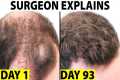 Oral Minoxidil - A Better Hair Loss