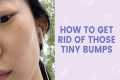 How to Get Rid of Those Tiny Bumps |