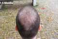 FUE Hair Transplant Timeline I Day 1