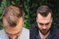 Hair Transplant Result with 3040